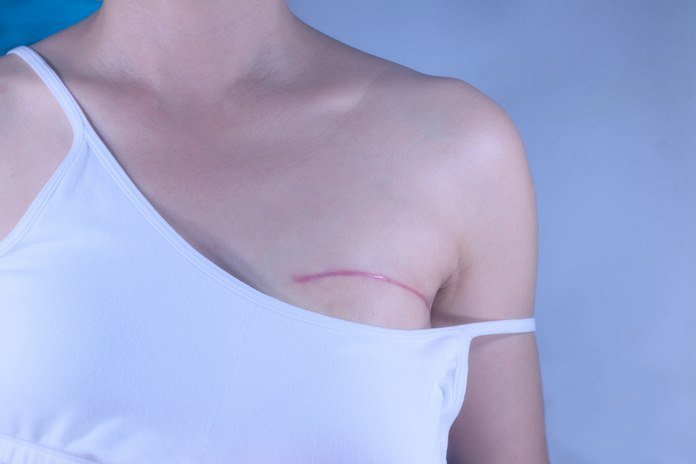 Photo d'une femme avec une blouse blanche. La bretelle de son bras gauche est descendue sur le bras. Elle a une cicatrice au dessus du sein gauche.